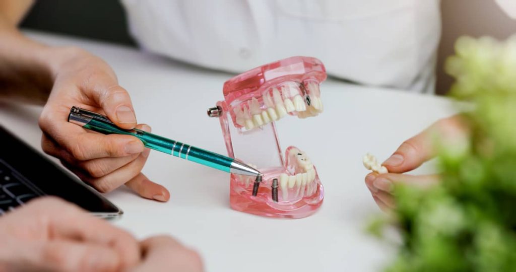 medicul stomatolog explica procedura de implant dentar folosind un model 3D al arcadelor dentare