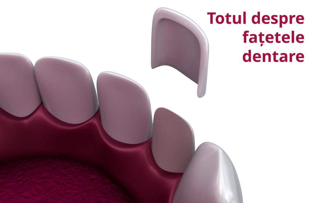 Totul despre fațetele dentare