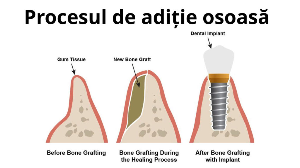 Imaginea arată procesul de adiție osoasă: înainte (os resorbit), în timpul vindecării (os nou adăugat) și după (os refăcut cu implant dentar).