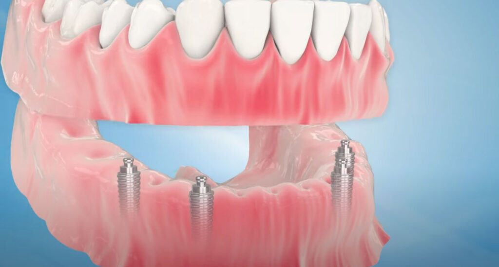 Tot ce trebuie să știi despre costul unui implant dentar pentru toată gura