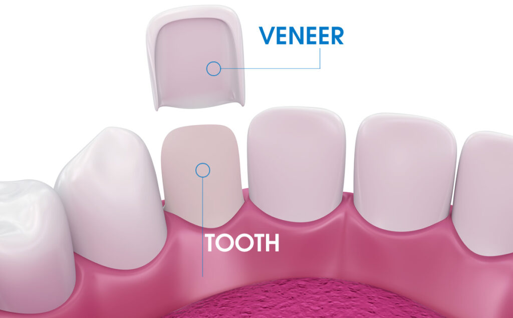 Cât costă fațetele dentare?